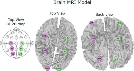 Brain MRI Showing Electrode Placement